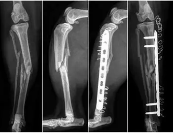 fracture du tibia