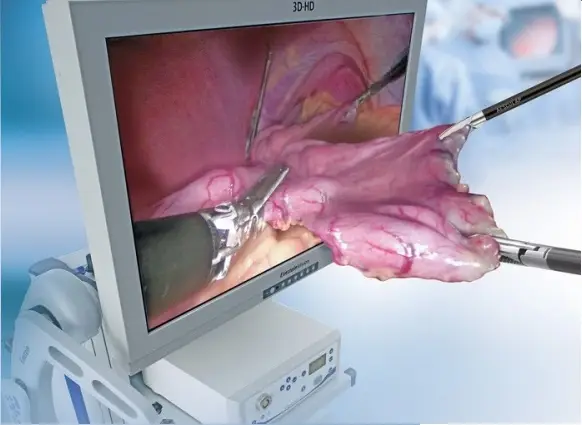 La coeliscopie en 3D