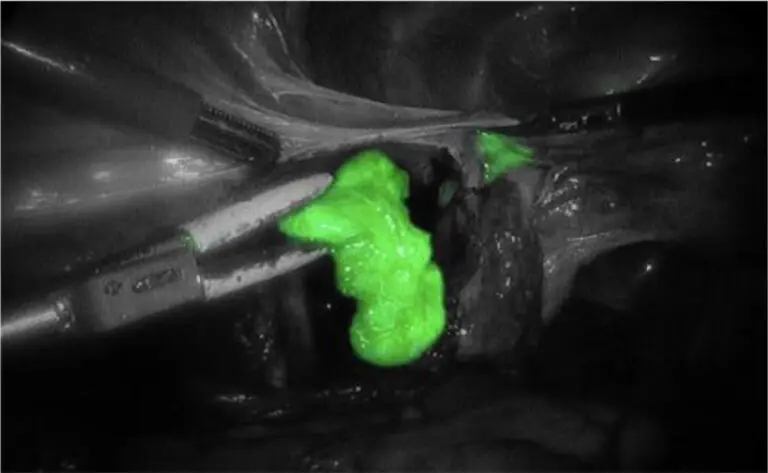 Marquage d'un ganglion par fluorescence